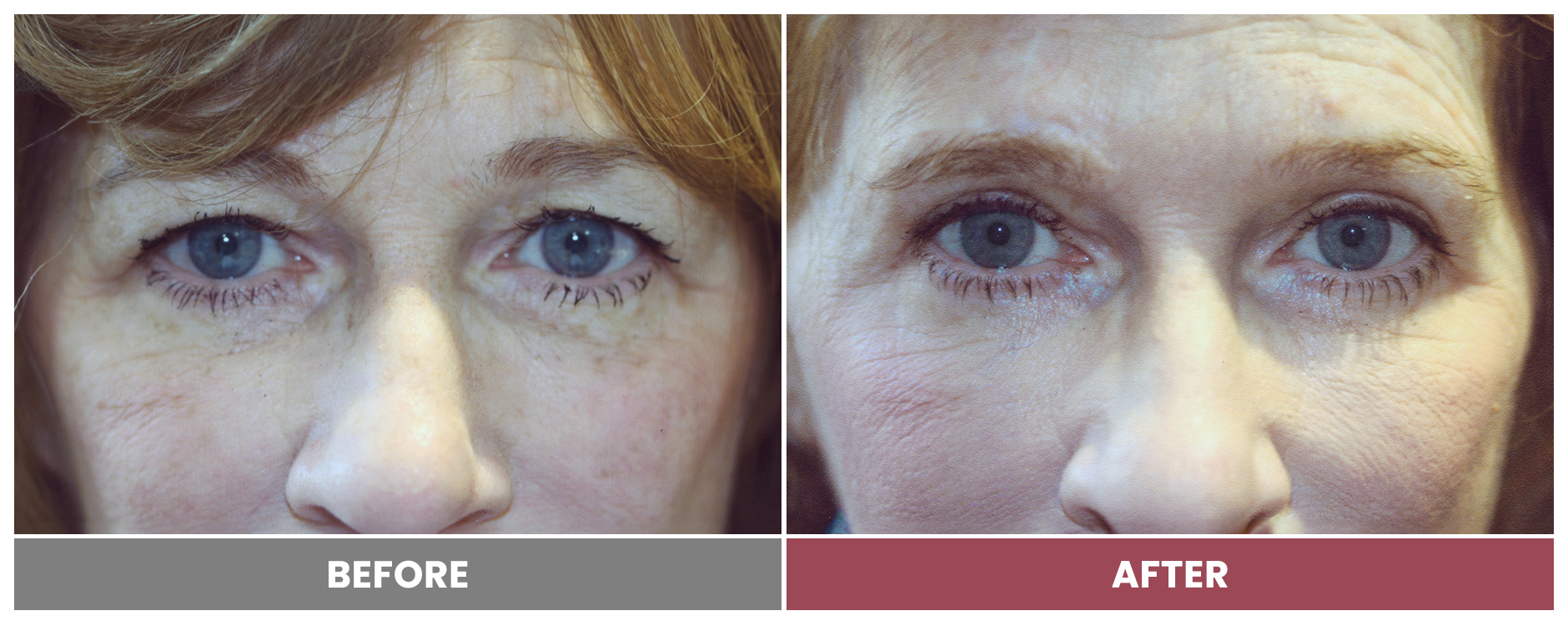 Upper Blepharoplasty - Case 2
